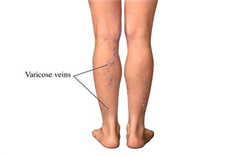 Varicose Veins - Varicose Veins | NHLBI, NIH