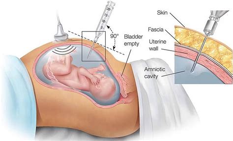 Amniocentesis - Test Accuracy, Risks, Complications