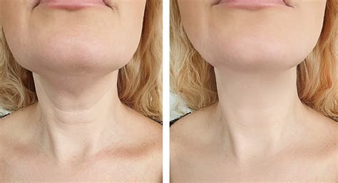 Neck Botox: The Procedure, Risks, Aftercare and Benefits - VibrantSkinBar