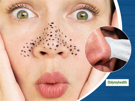 Blackheads On Face? Here Are The Causes, Symptoms And Treatment ...