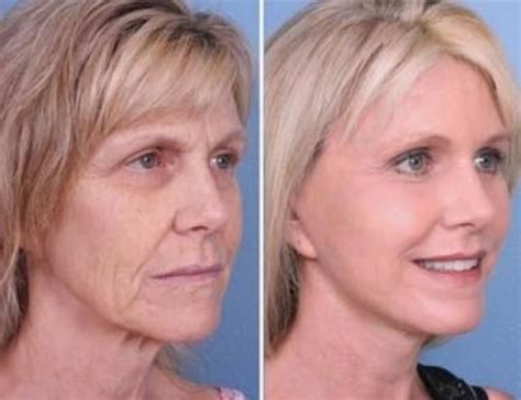 Conduct Your Own Facelift Without Surgery Via Facelift Yoga Workouts ...