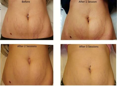 Laser Stretch Mark Removal: Doctor’s Review, Before & After ...