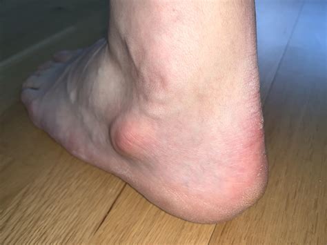 Why do I have an extra bump below the ankle joint? : r/Podiatry