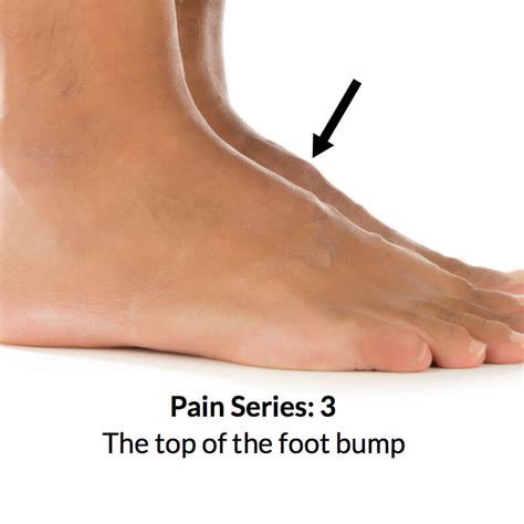 Tarsal Boss Foot Bump - Consulting Footpain