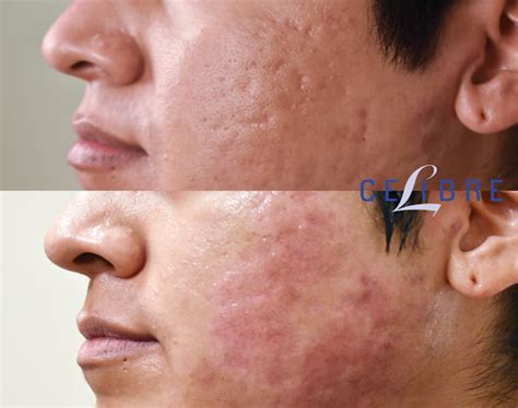 Laser Treatment For Acne Scars: What To Expect, Cost, And, 52% OFF