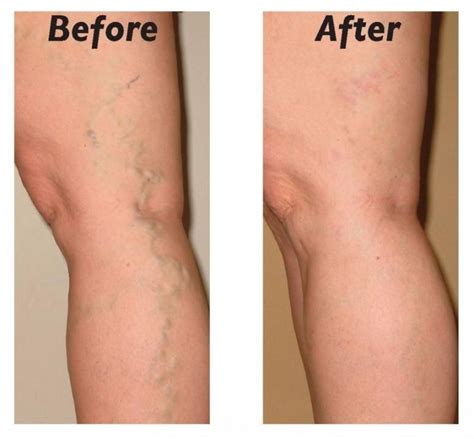 Treat Varicose And Spider Veins With These 10 Simple Steps Varicose ...