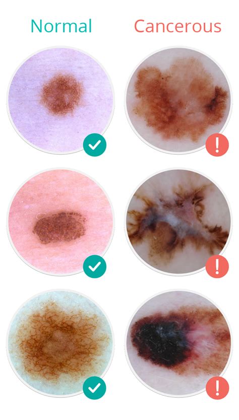 First Signs Of Skin Cancer