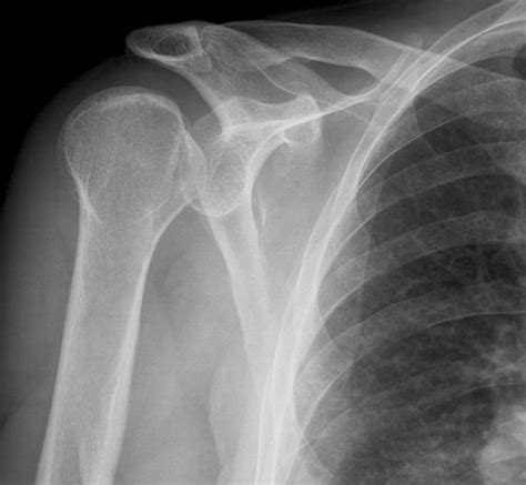 Shoulder Dislocation X Ray