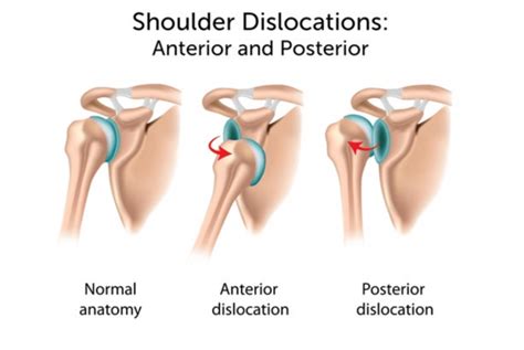 Shoulder Subluxation Versus Dislocation: Which sports do these occur in ...