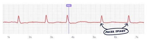 What Paced Rhythm Looks Like on Your Watch ECG | Qaly