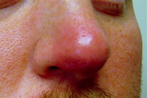 The Rudolph sign of nasal vestibular furunculosis: Questions raised by ...