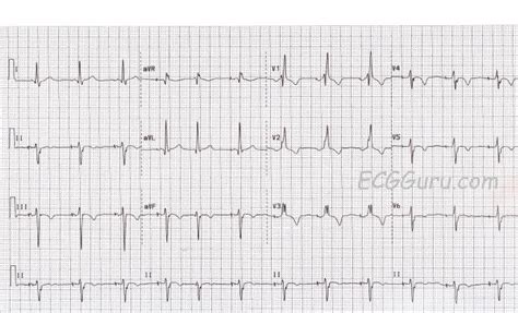 Atrial Pacing With Right Bundle Branch Block | ECG Guru - Instructor ...