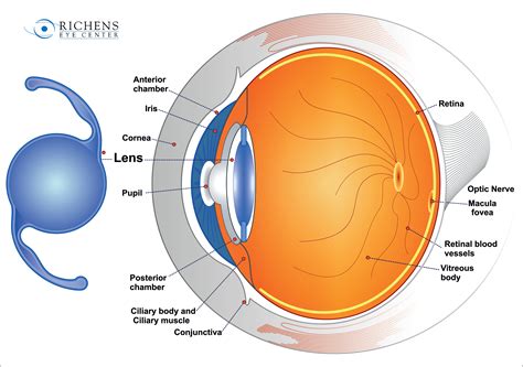 Richens Eye Center offers a closer look at cataract surgery and ...