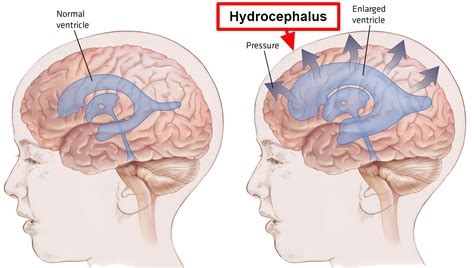 Hydrocephalus - Causes, Symptoms In Babies & Adults, Treatment