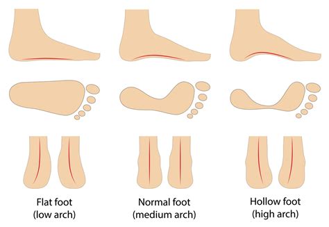 Know your Arch type: Gotham Footcare: Podiatrists (2023)