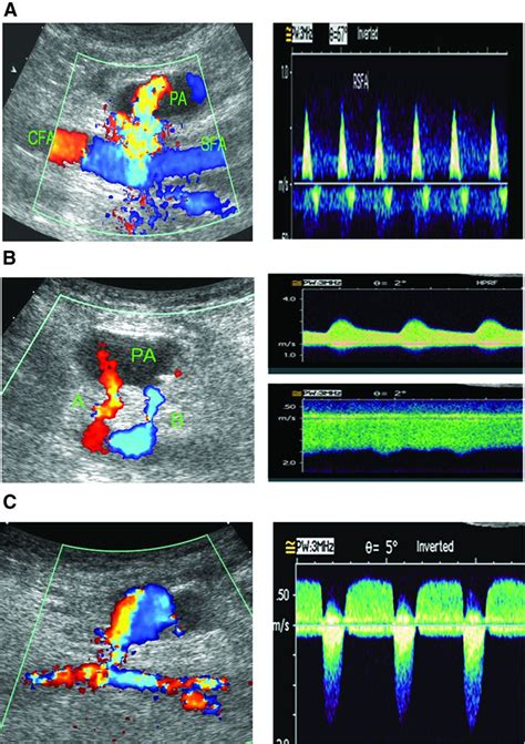 Femoral Av Fistula Ultrasound