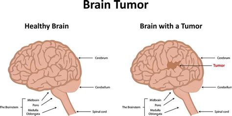 14 Brain Tumors Warning Signs; Symptoms of Brain Tumor - Left Side Pains