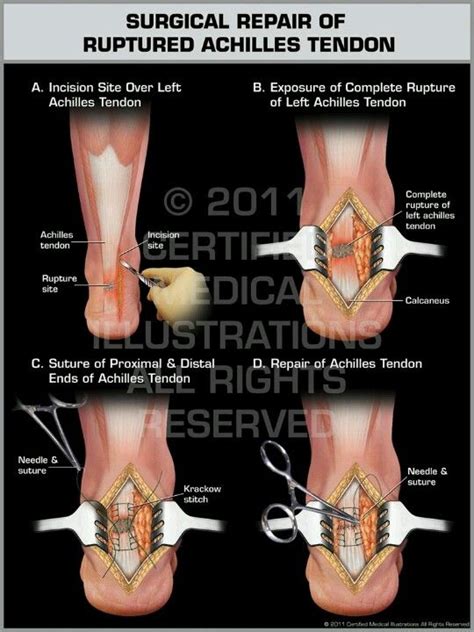 1000+ images about Achilles' tendon surgery on Pinterest | Calf ...