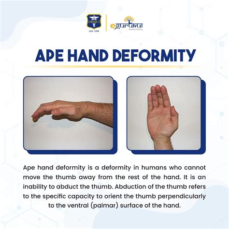 DBMCI Egurukul - Ape hand deformity is a deformity in...