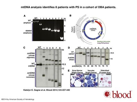 MtDNA analysis identifies 8 patients with PS in a cohort of DBA ...