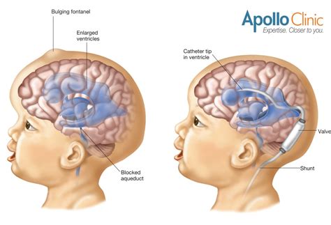 Hydrocephalus: A Neurological Condition and its Treatments | Apollo Clinic