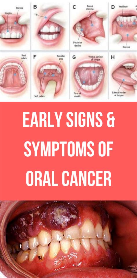 Early Signs & Symptoms of Oral Cancer | Wellness tab