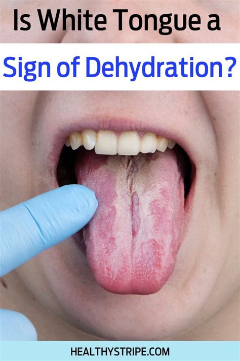 Is White Tongue a Sign of Dehydration? in 2022 | Signs of dehydration ...