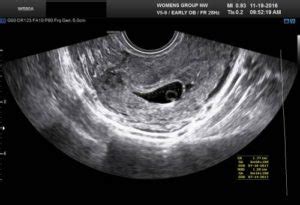 4 Weeks Pregnant Ultrasound: Pictures and Description | IYTmed.com