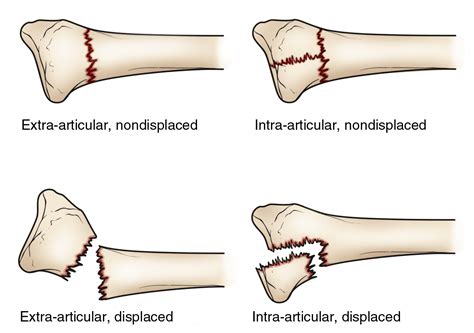 Distal Radius Fractures (Broken Wrist) - OrthoInfo - AAOS