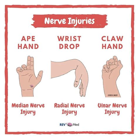 Doctor Medicine on Instagram: “ ️Median Nerve “Ape Hand ...