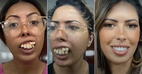 Lady With Crooked Teeth Shows off Transformation After Undergoing ...