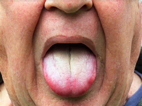 White Tongue Causes & 11 Natural Remedies to Make It Healthier - Origin ...