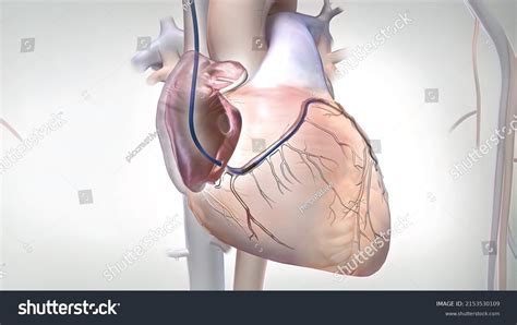 601 Coronary artery bypass grafting Images, Stock Photos & Vectors ...