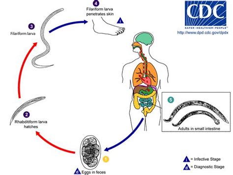 Hookworm Infection - Infectious Diseases - MSD Manual Professional Edition