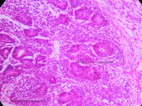 Wilm’s tumor – UG slide – Histopathology.guru