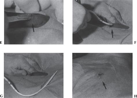 Catheter and Port Removal: Techniques and Follow-Up Care | Thoracic Key