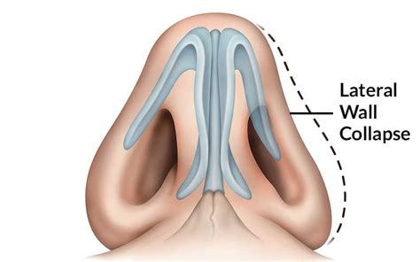 Nasal Valve Collapse St. Louis, MO | Nasal Valve Collapse Treatment