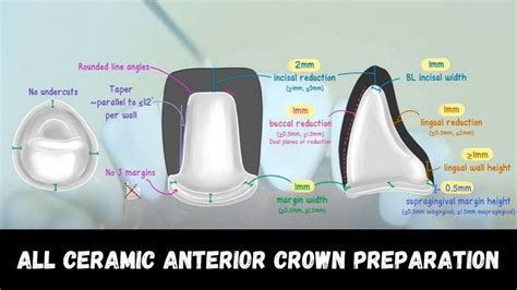 ALL CERAMIC ANTERIOR CROWN PREPARATION Step by Step - Dr. Peter Grieco