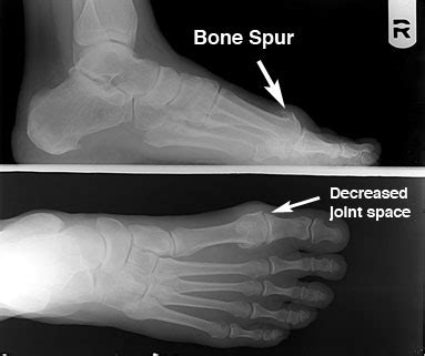 Why That Bump on Top of Your Foot Causes Pain...Step After Step ...