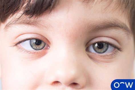 Lazy Eye (Amblyopia): Causes, Symptoms, Diagnosis, and Treatment