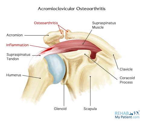 Acromioclavicular Joint Arthritis Treatment - Quotes Resume