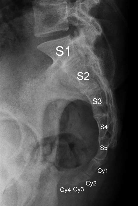 Imaging Coccygeal Trauma and Coccydynia | RadioGraphics