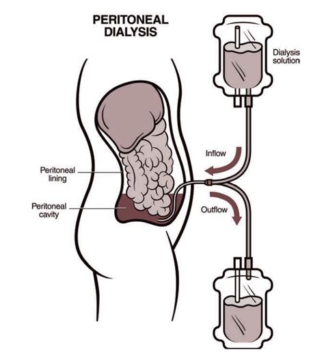 Peritoneal Dialysis Catheter Types