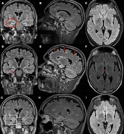 Cerebral atrophy causes, symptoms, diagnosis, treatment & prognosis