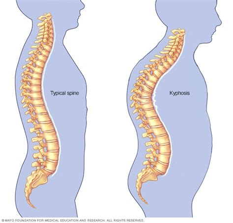 Kyphosis - Mayo Clinic