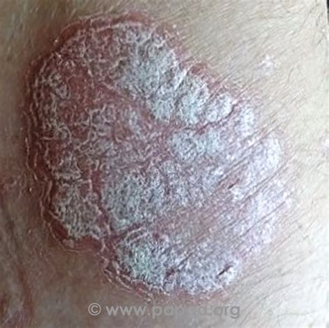 Psoriasis Knee