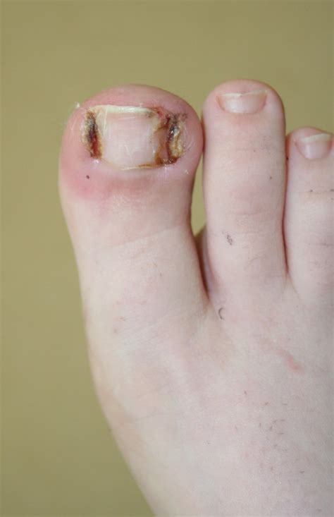 Ingrown Toenail Surgery - Buderim Podiatry | Sunshine Coast podiatrist ...