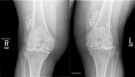 Osteoporosis Of Knee - Human Anatomy