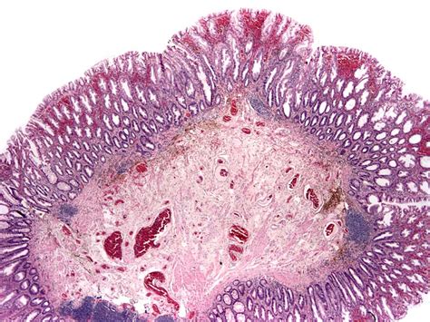 Pathology Outlines - Sessile serrated adenoma