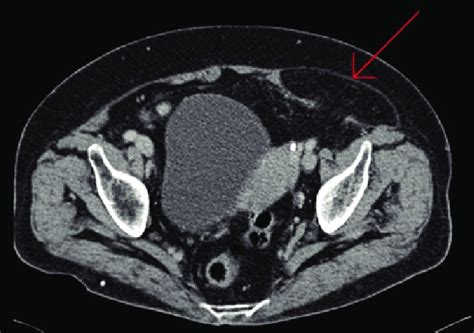 Imagen de tomografía abdominal que muestra una hernia de Spiegel ...